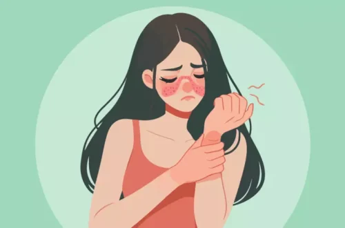 Understanding Lupus Flares: Triggers, Symptoms, and Management