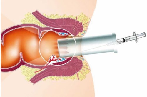 Minimally Invasive Hemorrhoid Procedures (Banding, Sclerotherapy)
