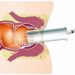 Minimally Invasive Hemorrhoid Procedures (Banding, Sclerotherapy)