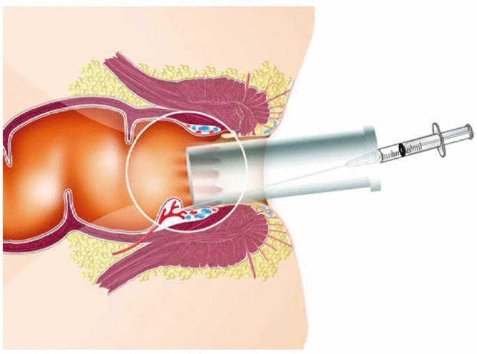 Minimally Invasive Hemorrhoid Procedures (Banding, Sclerotherapy)