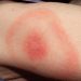 Recognizing the Early Signs of Lyme Disease (Especially the Bullseye Rash)