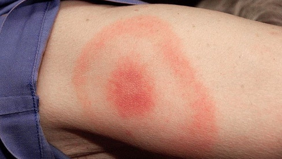 Recognizing the Early Signs of Lyme Disease (Especially the Bullseye Rash)