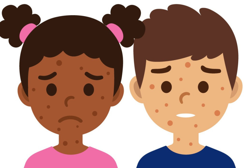 Measles Outbreaks: Causes and Global Impact