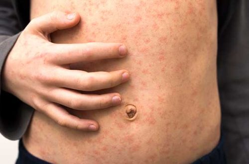 Measles in Adults: Risks and Severity