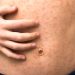 Measles in Adults: Risks and Severity