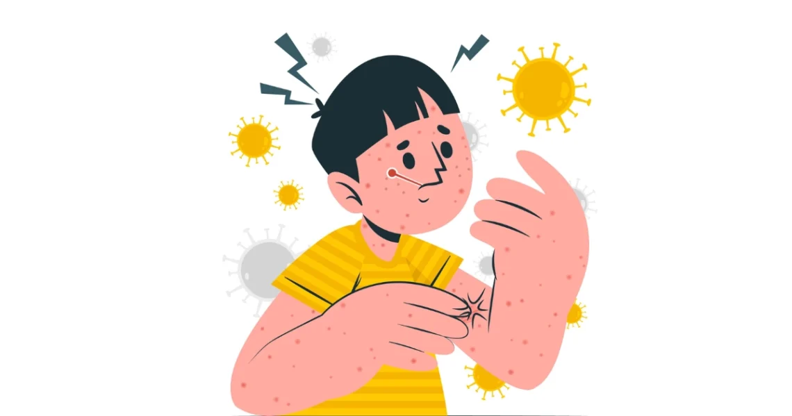 Measles Symptoms: The Rash, Fever, Cough, and Koplik's Spots