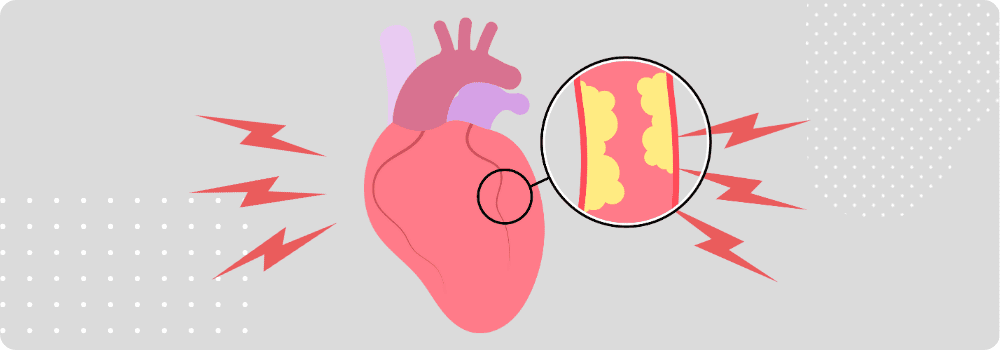 Understanding Angina: Types, Triggers, and Treatment