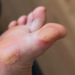 Preventing Diabetic Complications: Foot, Eye, Kidney, and Nerve Care