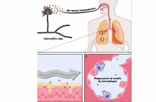 Bacterial vs. Viral vs. Fungal Pneumonia: Causes and Treatment Paths
