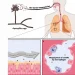 Bacterial vs. Viral vs. Fungal Pneumonia: Causes and Treatment Paths
