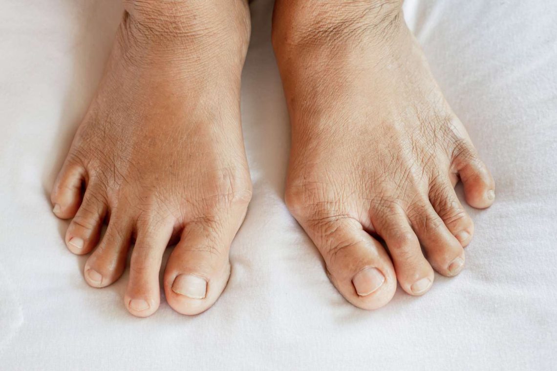 Early Signs of Arthritis: When to Seek Evaluation