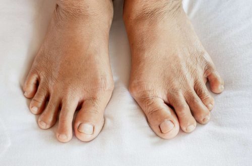 Early Signs of Arthritis: When to Seek Evaluation