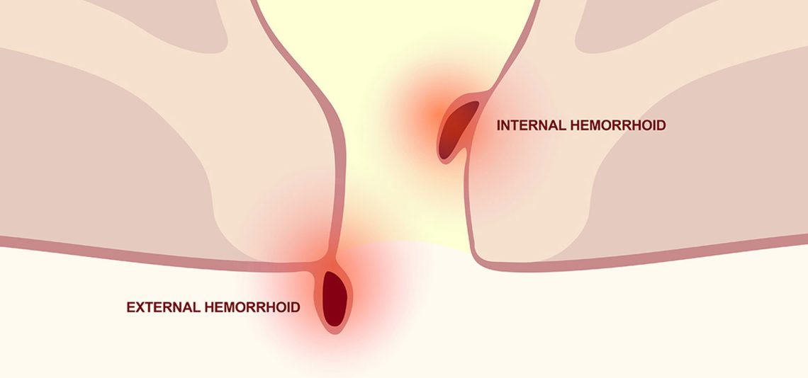 Bleeding Hemorrhoids: Understanding Causes and When It's Serious
