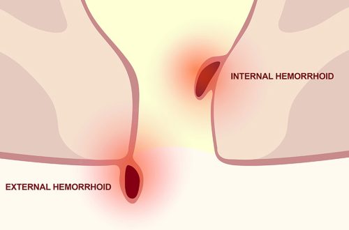 Bleeding Hemorrhoids: Understanding Causes and When It's Serious