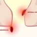 Bleeding Hemorrhoids: Understanding Causes and When It's Serious