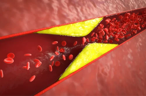 Familial Hypercholesterolemia: Recognizing and Managing Inherited High Cholesterol