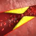 Familial Hypercholesterolemia: Recognizing and Managing Inherited High Cholesterol