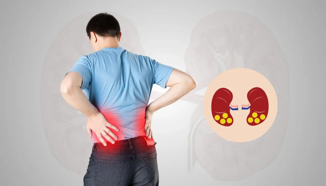 Kidney Stone Pain: What to Expect & How to Manage It