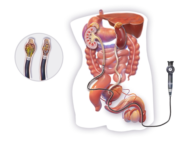 Non-Surgical Stone Treatments: ESWL & Ureteroscopy Explained