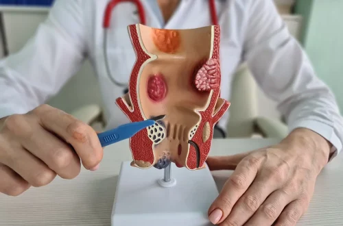 Internal vs. External Hemorrhoids: Symptoms, Differences, and Treatments