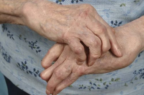 Arthritis in Hands: Managing Pain, Stiffness, and Maintaining Function