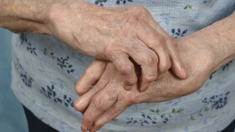 Arthritis in Hands: Managing Pain, Stiffness, and Maintaining Function