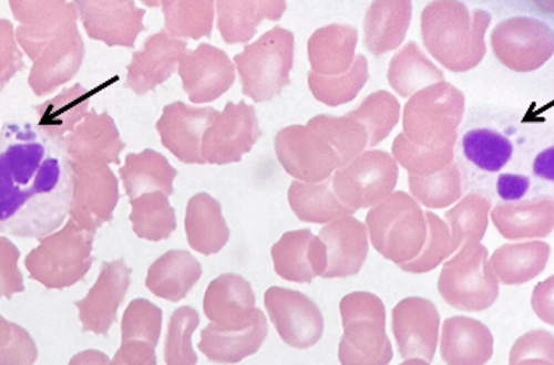 Co-Infections from Ticks: Babesiosis, Anaplasmosis, etc.