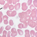Co-Infections from Ticks: Babesiosis, Anaplasmosis, etc.