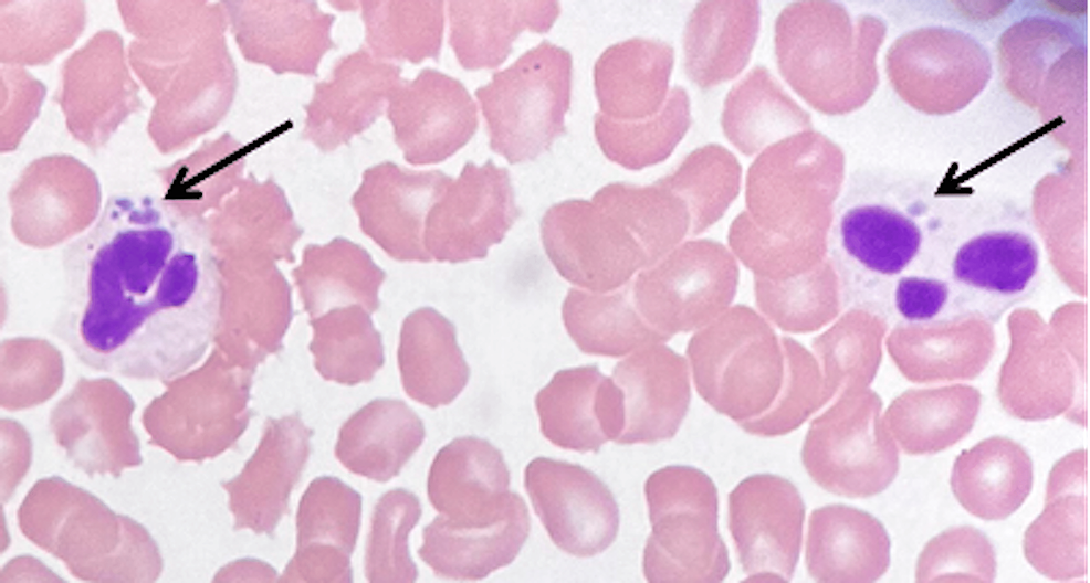 Co-Infections from Ticks: Babesiosis, Anaplasmosis, etc.