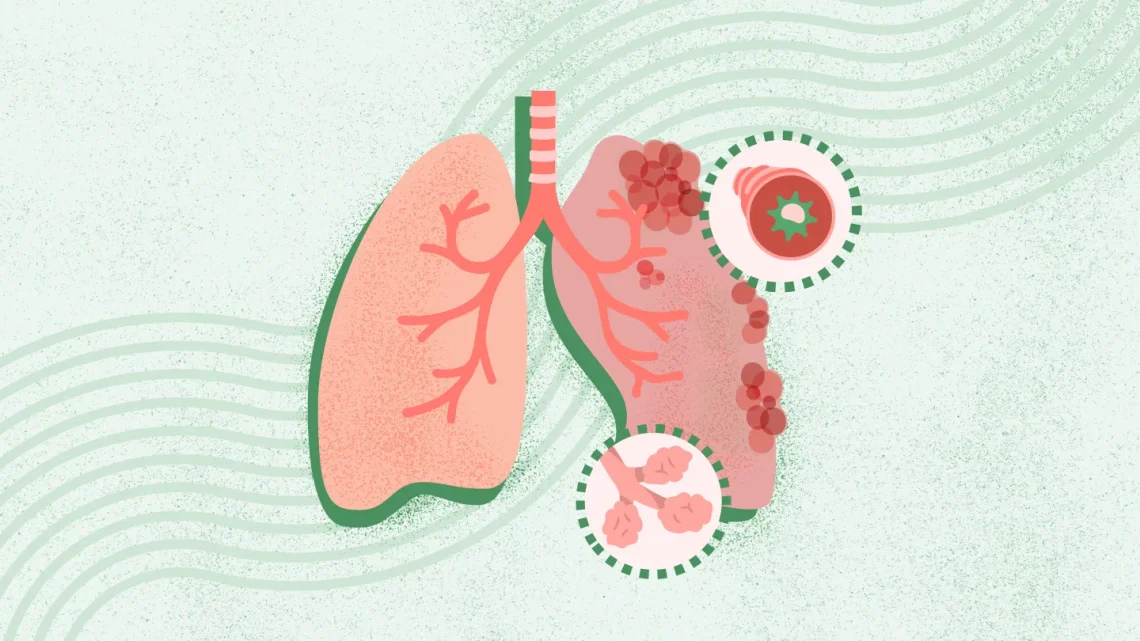 Is Bronchitis Contagious? Understanding Transmission and Prevention