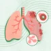 Is Bronchitis Contagious? Understanding Transmission and Prevention