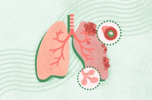 Complications of Pneumonia: Sepsis, Lung Abscess, and Pleural Effusion