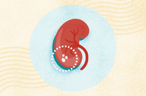 Underlying Conditions Linked to Kidney Stones (Hyperparathyroidism, UTIs)