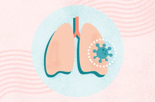 Bronchitis vs. Pneumonia: How to Tell Them Apart
