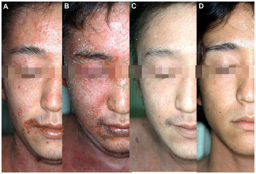 The Steroid Cream Trap: Adrenal Suppression and Withdrawal from Topical Hydrocortisone Overuse