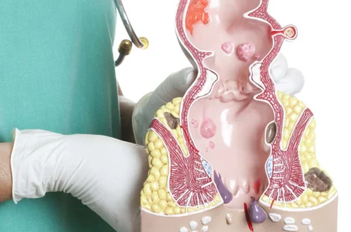 Thrombosed Hemorrhoids: Recognizing and Treating the Painful Complication