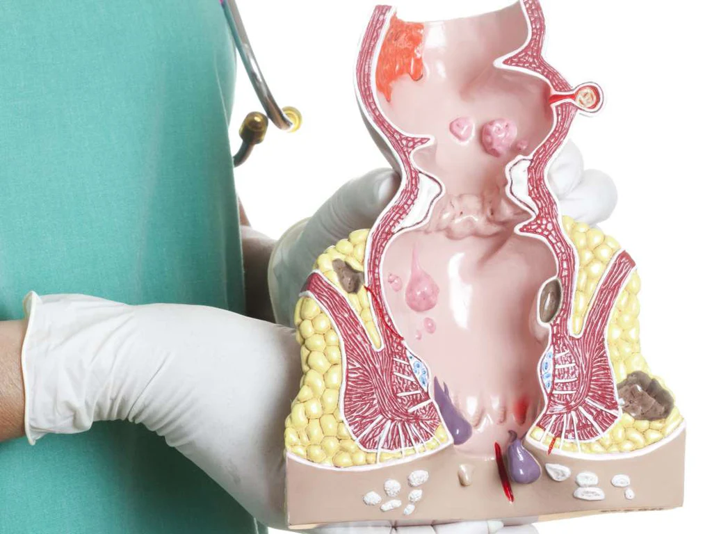 Thrombosed Hemorrhoids: Recognizing and Treating the Painful Complication