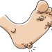 Genital Warts: Treatment Options and What to Expect
