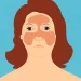 The Lupus "Butterfly Rash" and Other Common Skin Manifestations cartoon