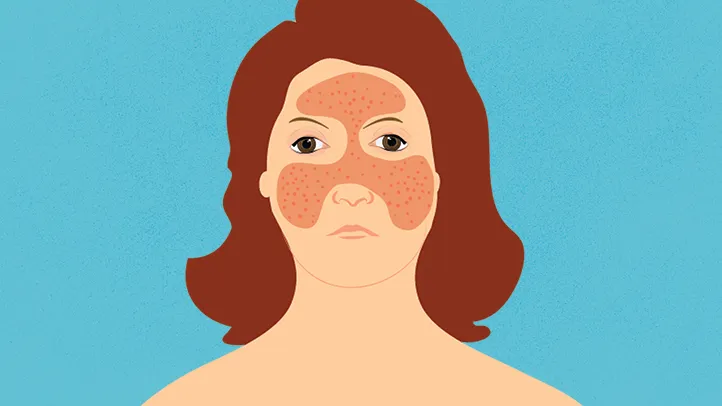 The Lupus "Butterfly Rash" and Other Common Skin Manifestations cartoon
