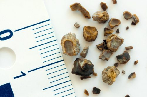 Preventing Recurrence: Long-Term Strategies After Your First Stone