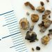 Preventing Recurrence: Long-Term Strategies After Your First Stone