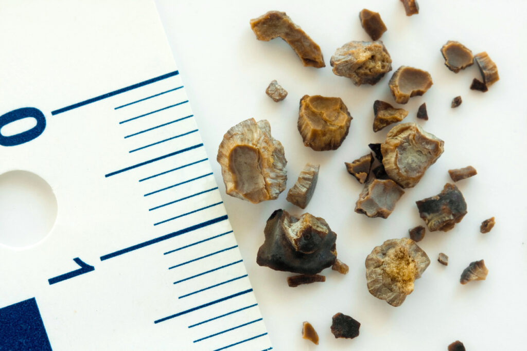 Preventing Recurrence: Long-Term Strategies After Your First Stone