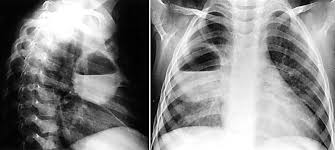Complications of Pneumonia: Sepsis, Lung Abscess, and Pleural Effusion