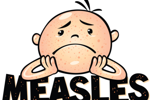 Measles Complications: Pneumonia, Encephalitis, SSPE