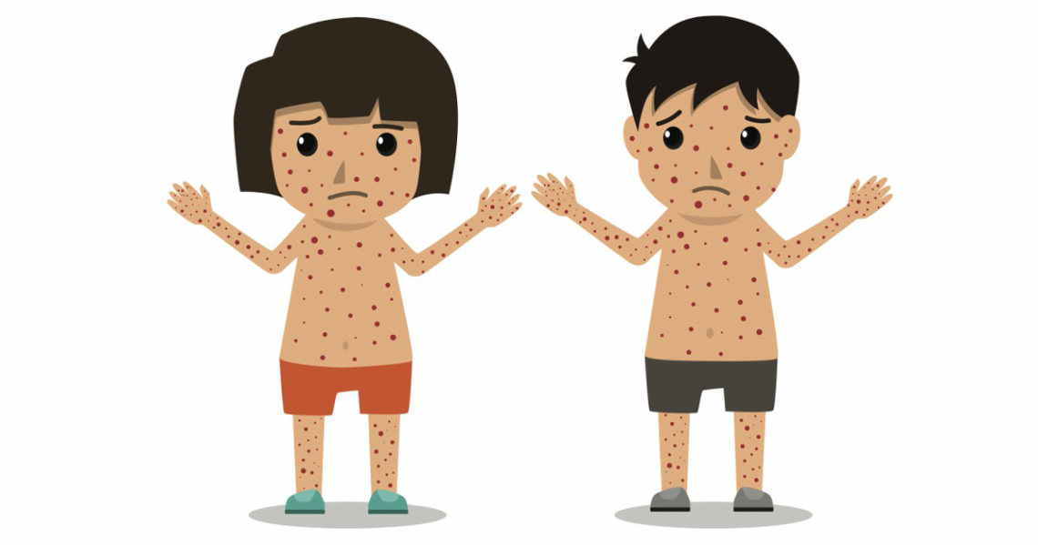 Why Measles is So Contagious (R0 Value Explained)