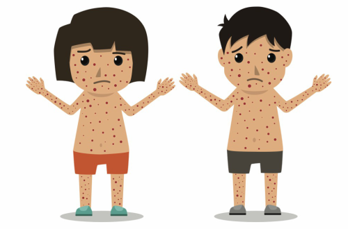 Why Measles is So Contagious (R0 Value Explained)