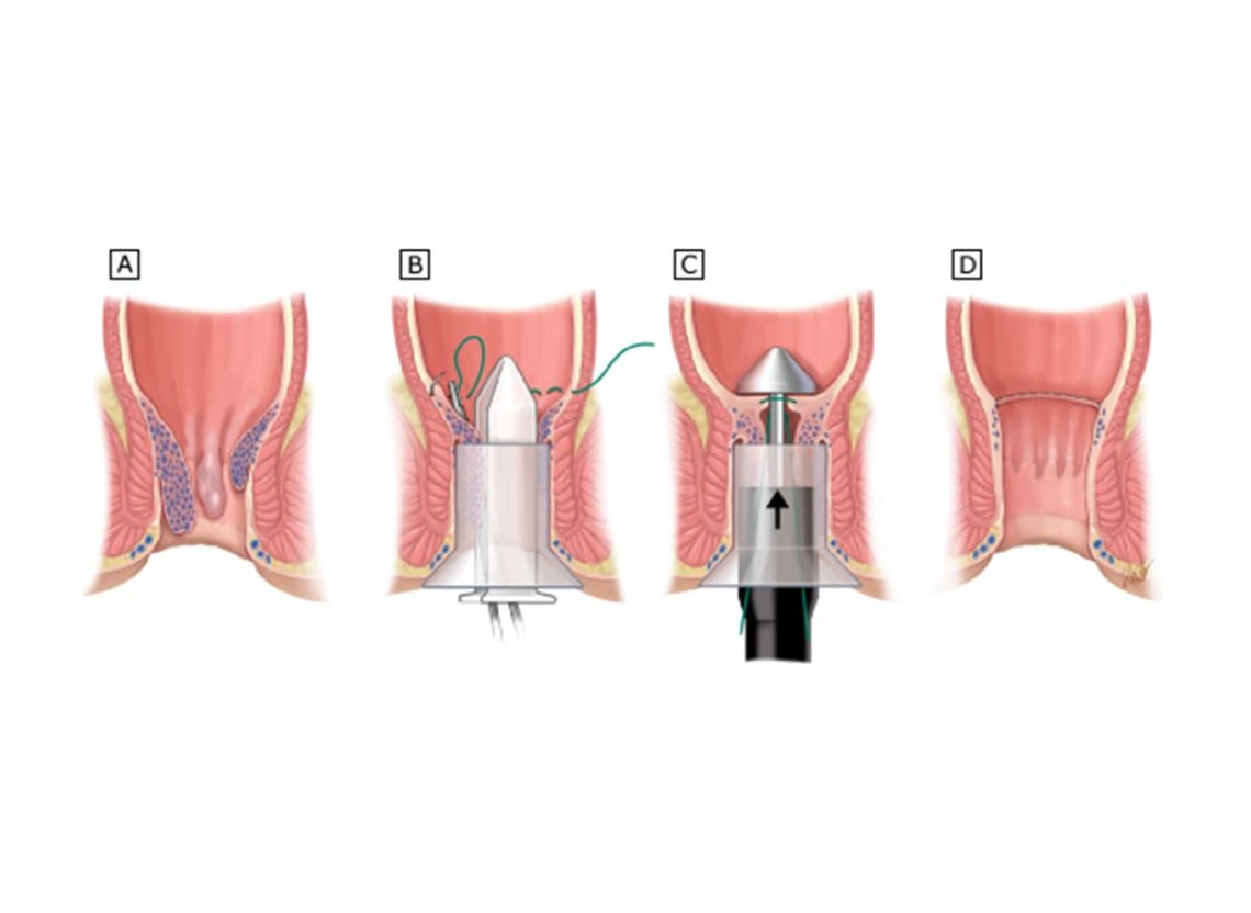 Surgical Options for Severe Hemorrhoids (Hemorrhoidectomy)