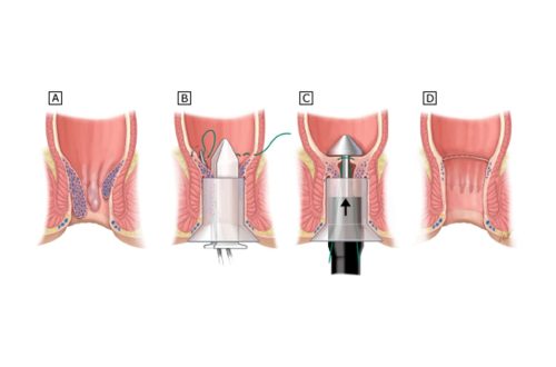 Surgical Options for Severe Hemorrhoids (Hemorrhoidectomy)