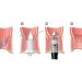 Surgical Options for Severe Hemorrhoids (Hemorrhoidectomy)